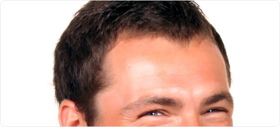 Forehead and brow lift for men