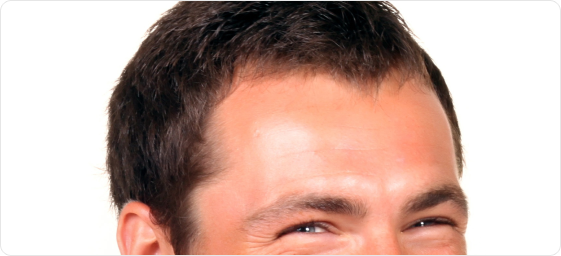 Forehead and brow lift for men Forehead and brow lift for men