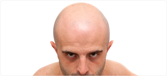 Hair transplant for men Hair transplant for men